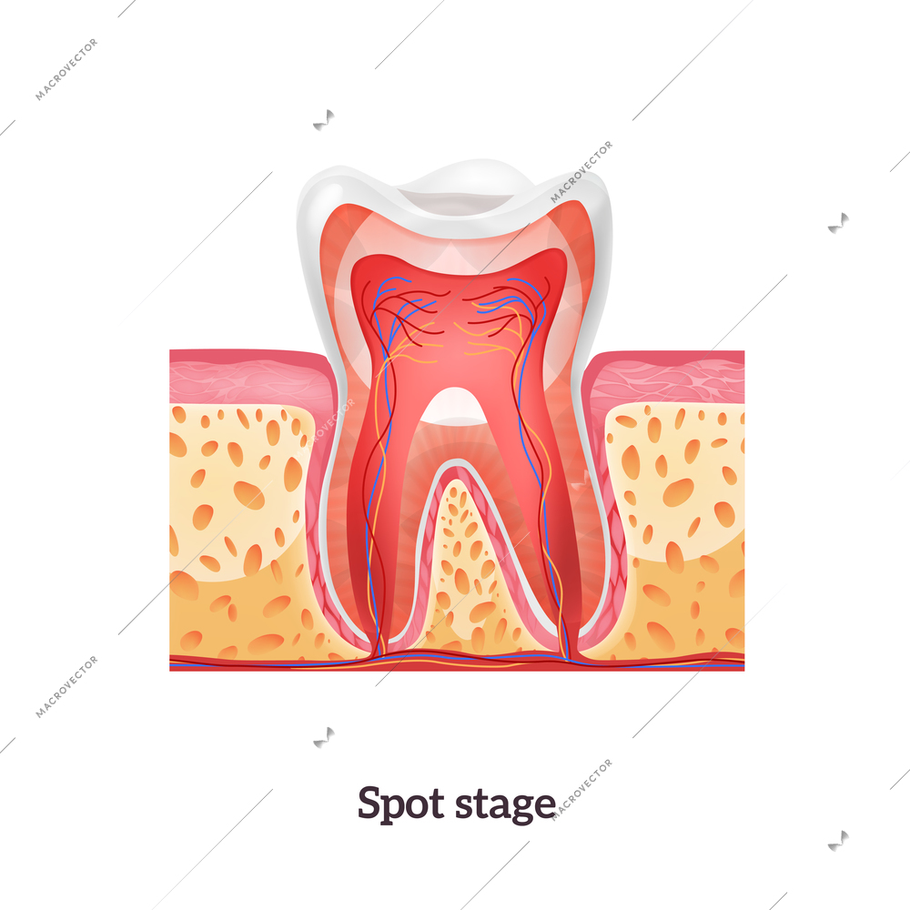 Tooth anatomy with spot stage of caries realistic vector illustration