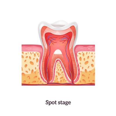 Tooth anatomy with spot stage of caries realistic vector illustration