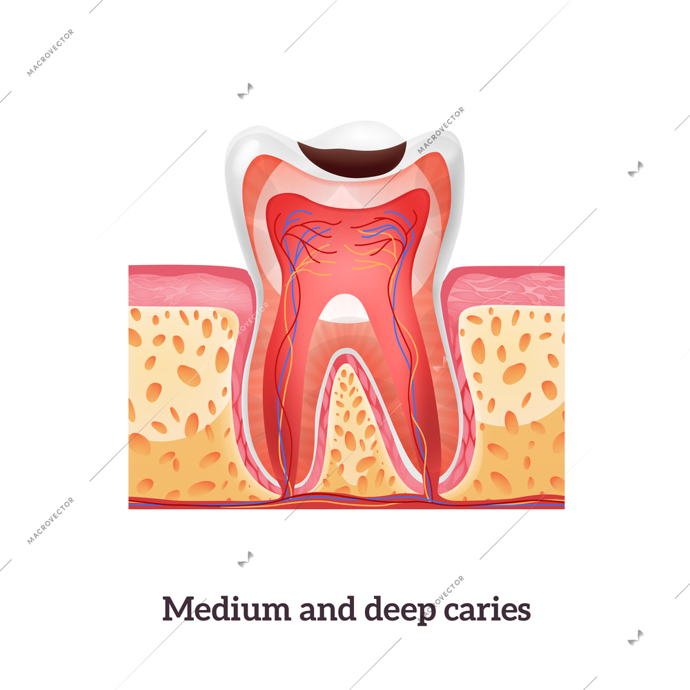 Realistic tooth structure with medium and deep caries vector illustration