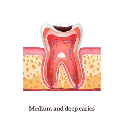 Realistic tooth structure with medium and deep caries vector illustration