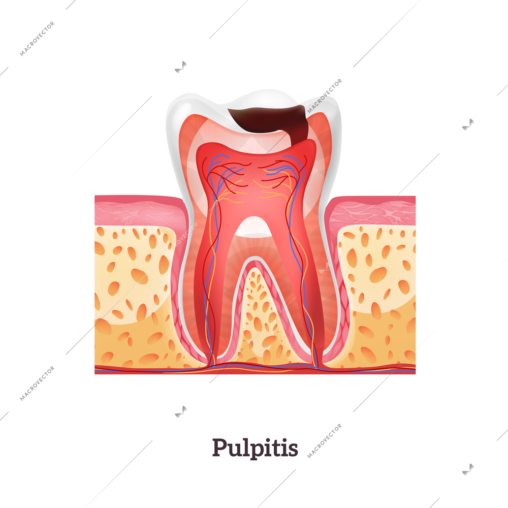 Pulpitis stage of tooth destruction realistic vector illustration