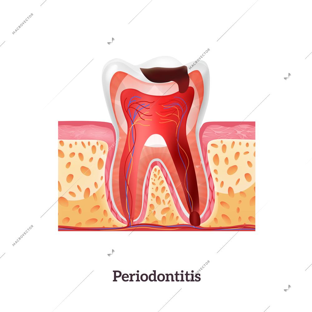 Unhealthy tooth with periodontitis realistic vector illustration