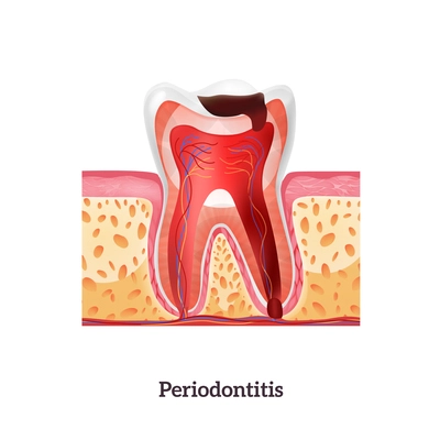 Unhealthy tooth with periodontitis realistic vector illustration