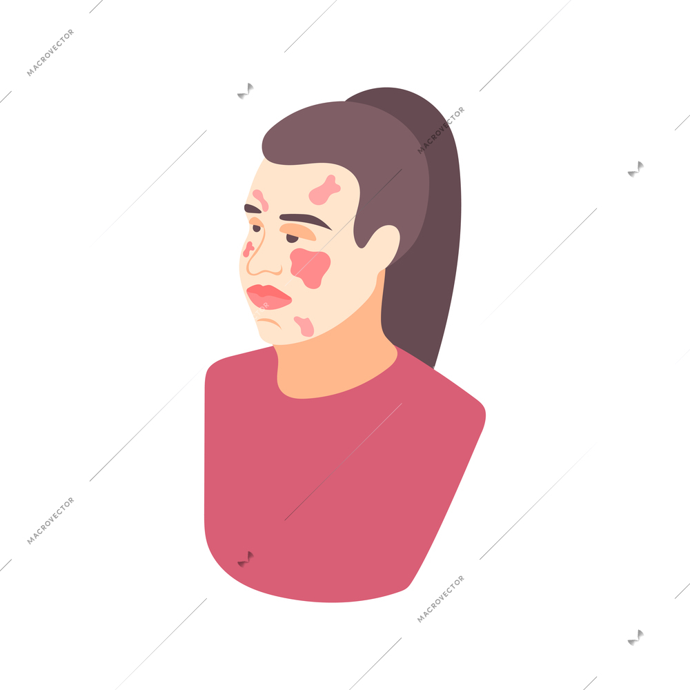 Allergy symptoms red swollen face isometric icon with female character vector illustration