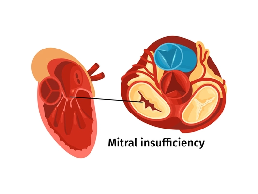 Heart disease anatomy flat poster with mitral insufficiency vector illustration
