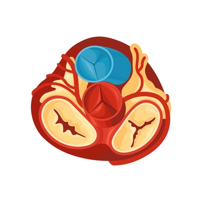 Diseased human heart anatomy mitral insufficiency flat vector illustration