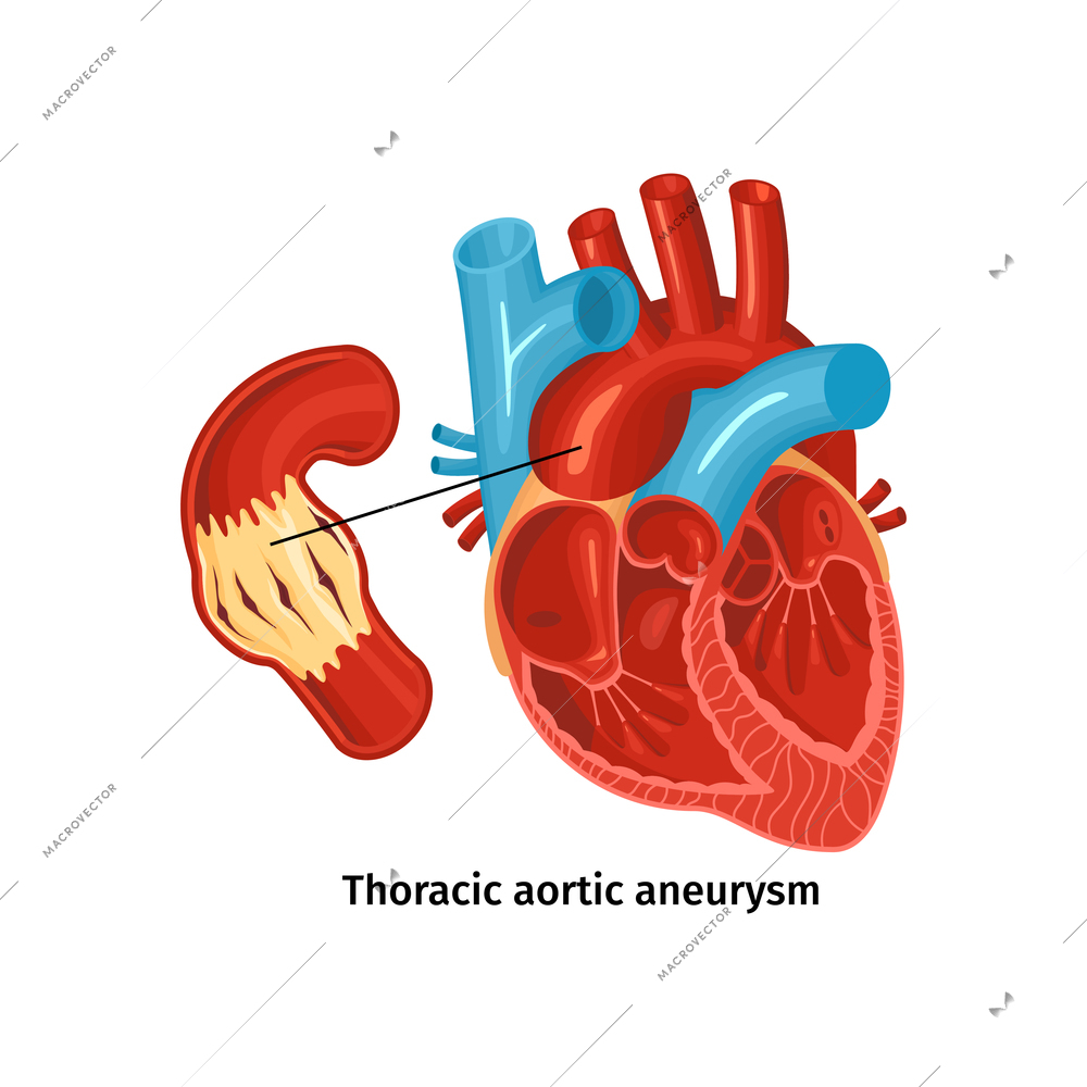 Heart disease anatomy poster with thoracic aortic aneurysm flat vector illustration