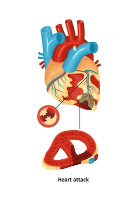 Flat color heart attack anatomy poster vector illustration