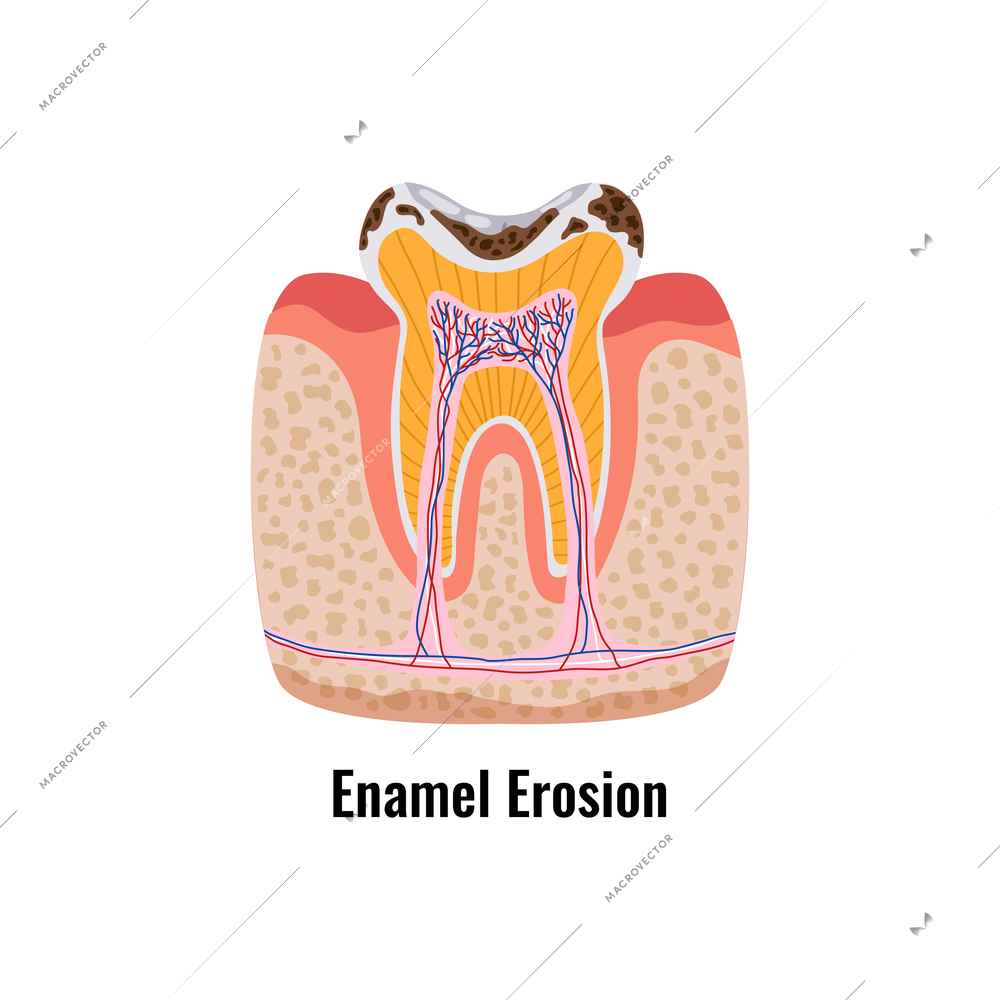 Dental oral problems poster in flat style with enamel erosion anatomy vector illustration