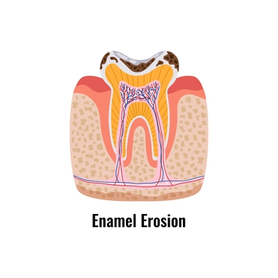 Dental oral problems poster in flat style with enamel erosion anatomy vector illustration