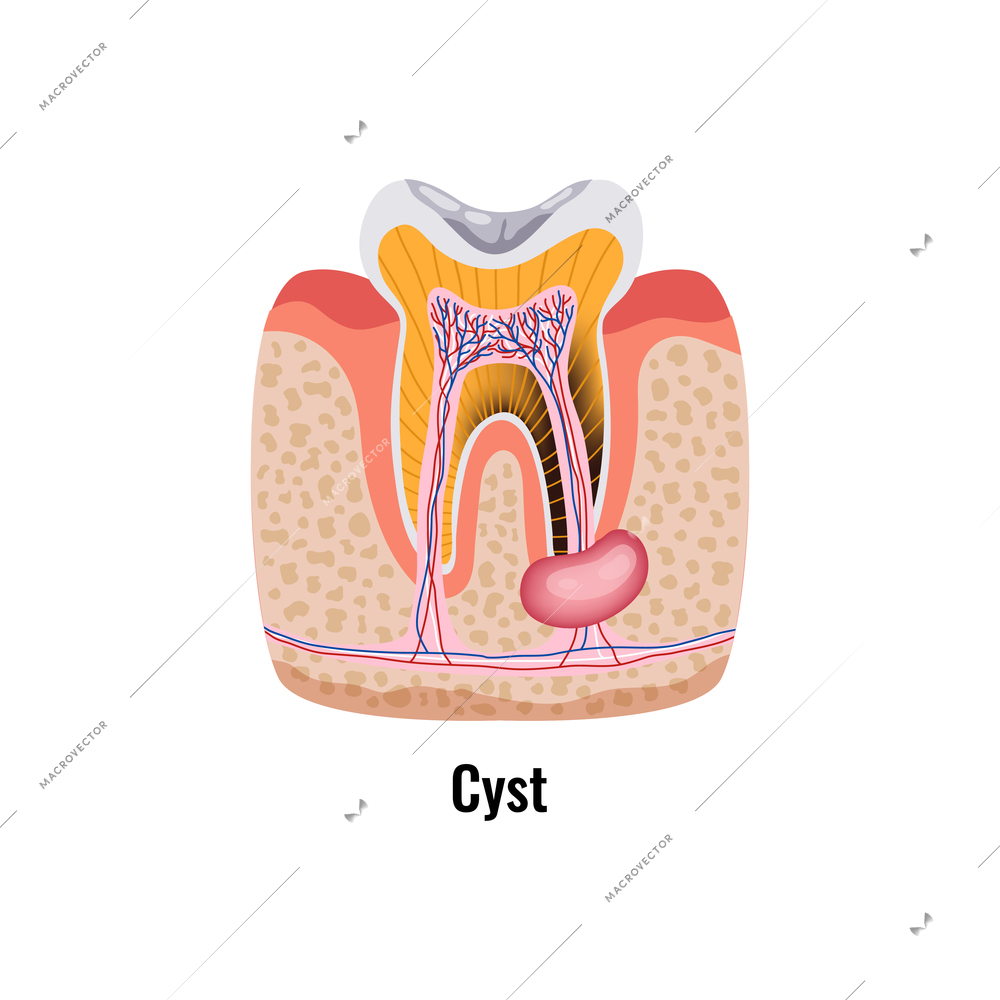 Dental oral problem flat poster and cyst in cavity anatomy vector illustration