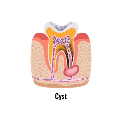 Dental oral problem flat poster and cyst in cavity anatomy vector illustration