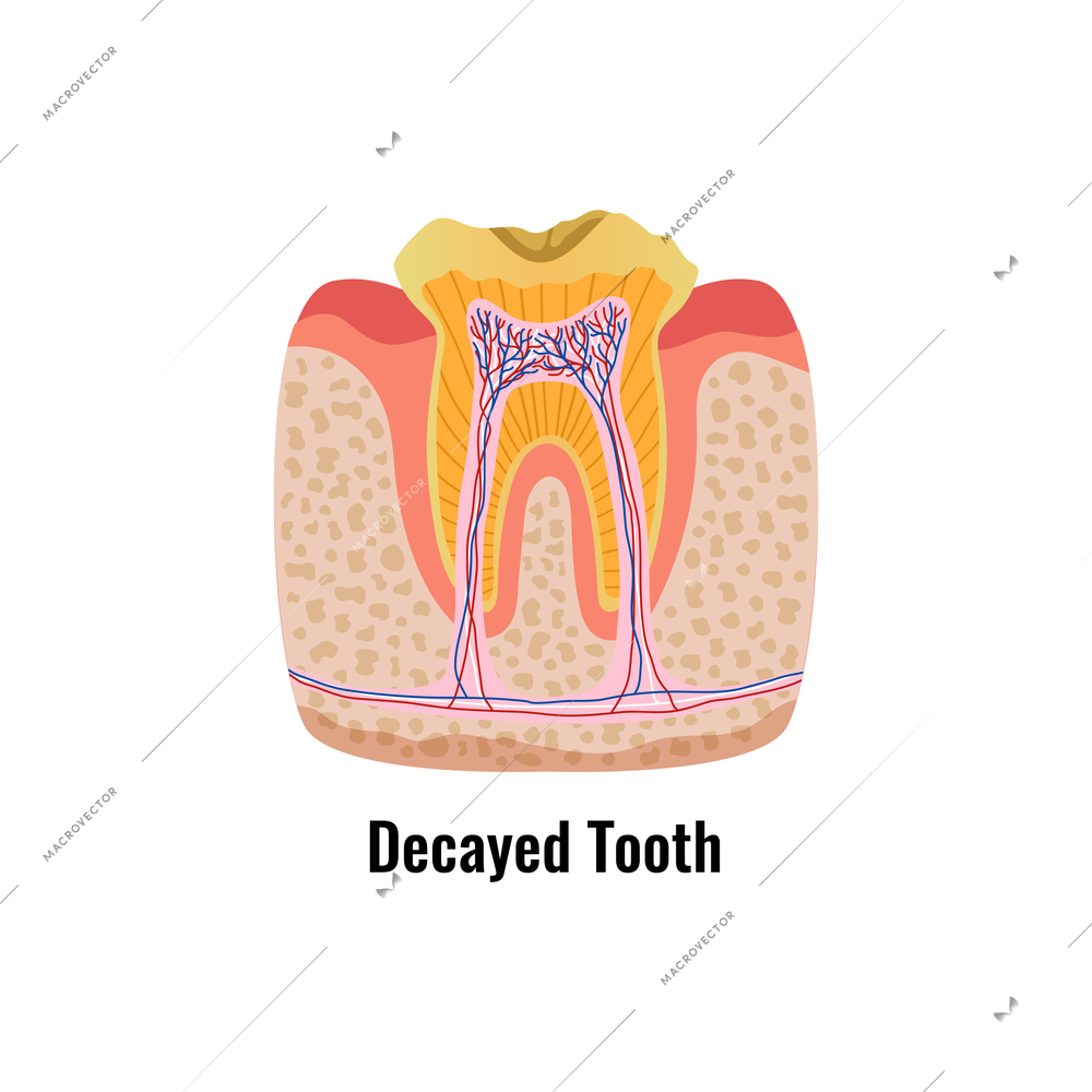 Flat poster with decayed tooth anatomy vector illustration