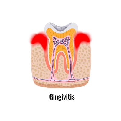 Dental oral problems poster with gingivitis tooth anatomy flat vector illustration