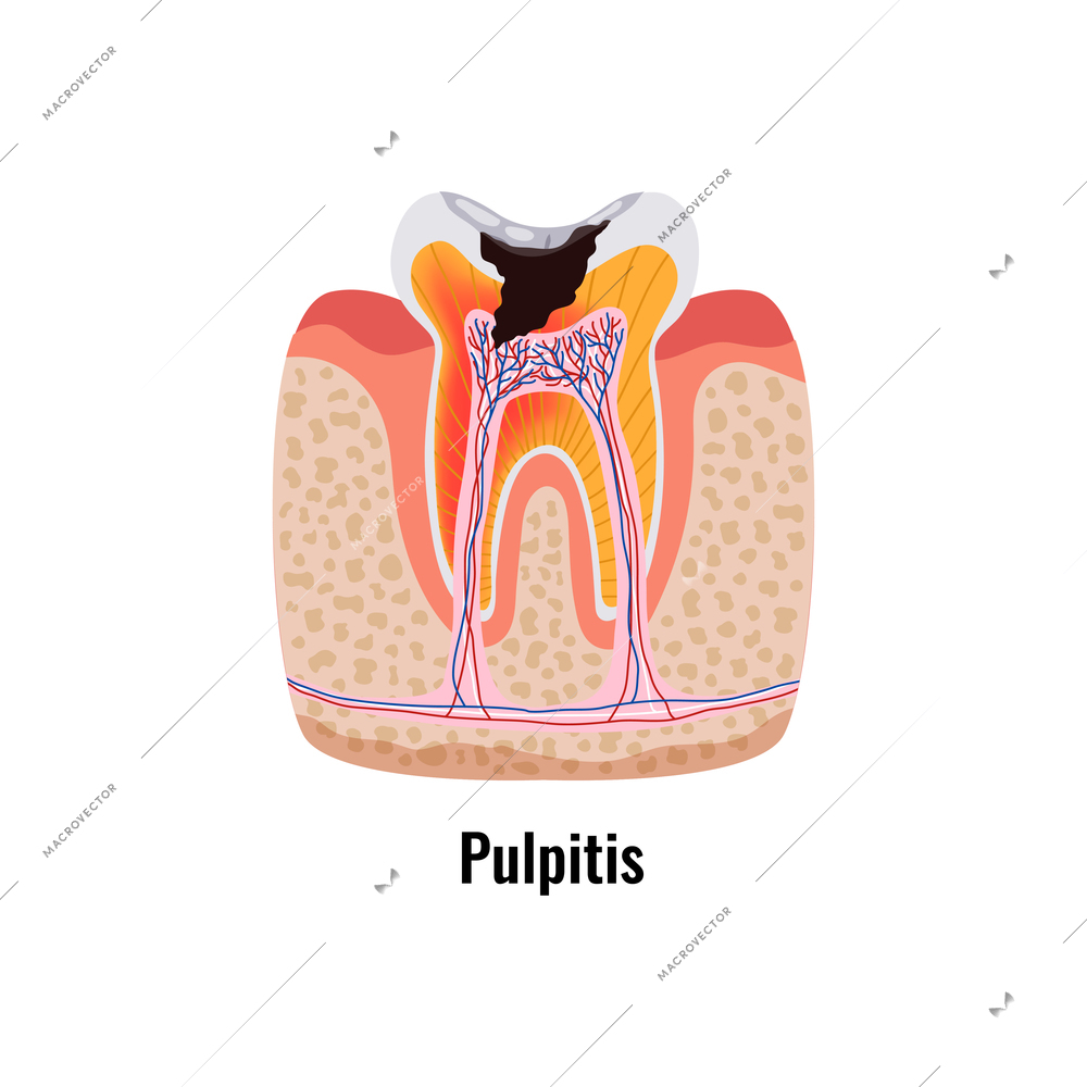 Dental disease flat poster with pulpitis anatomy vector illustration