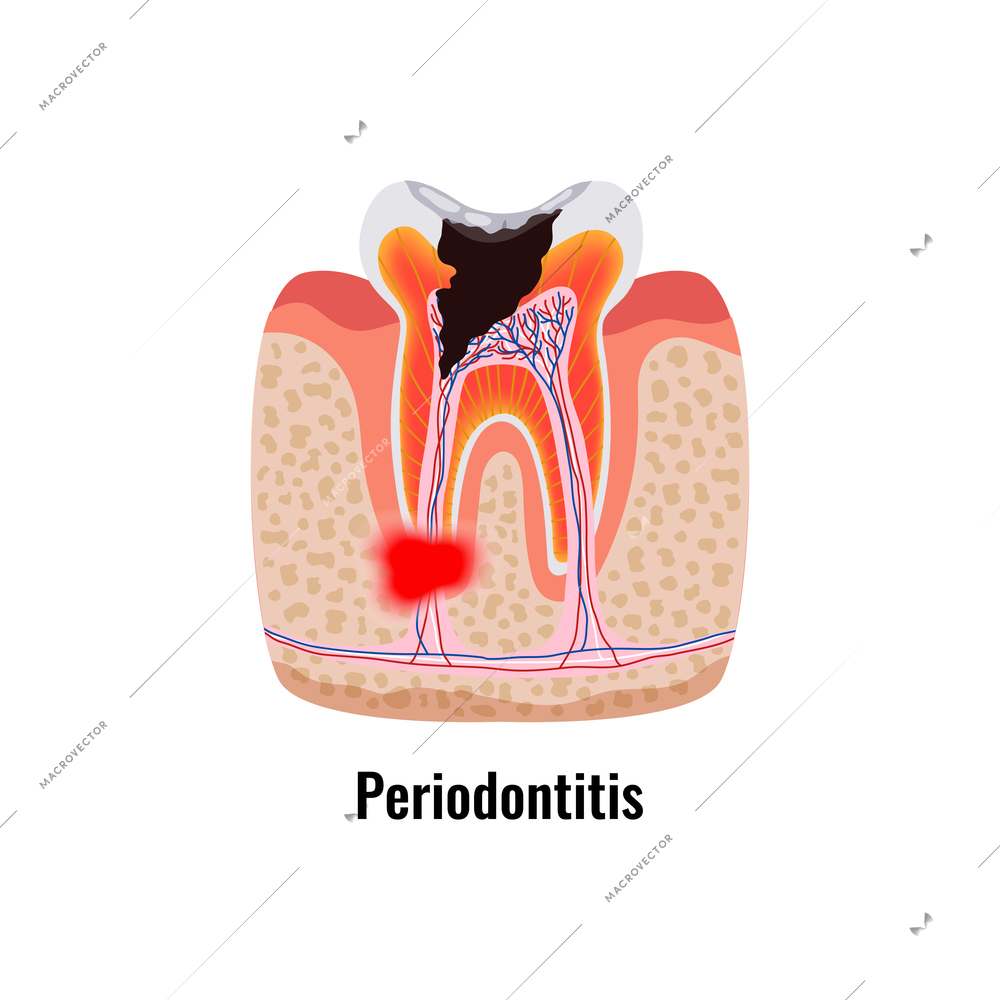 Dental oral problem poster with periodontitis tooth anatomy vector illustration