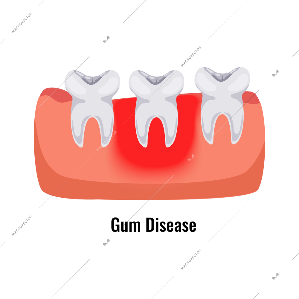 Dental oral problems flat poster with gum disease vector illustration