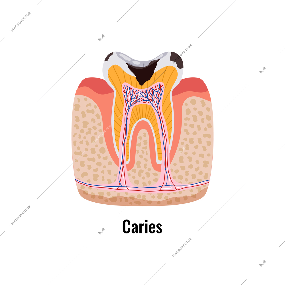 Dental oral problems caries flat poster with tooth anatomy vector illustration