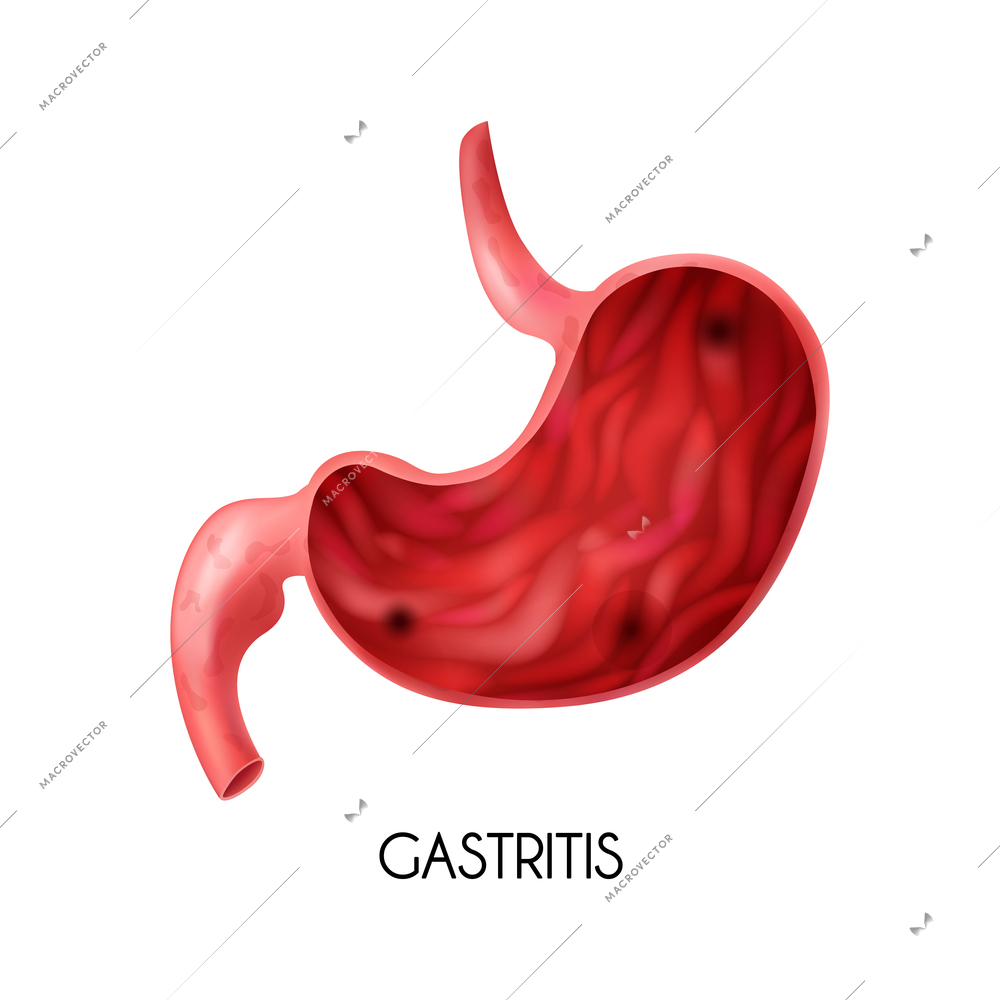 Realistic medical image of human stomach with gastritis on white background vector illustration