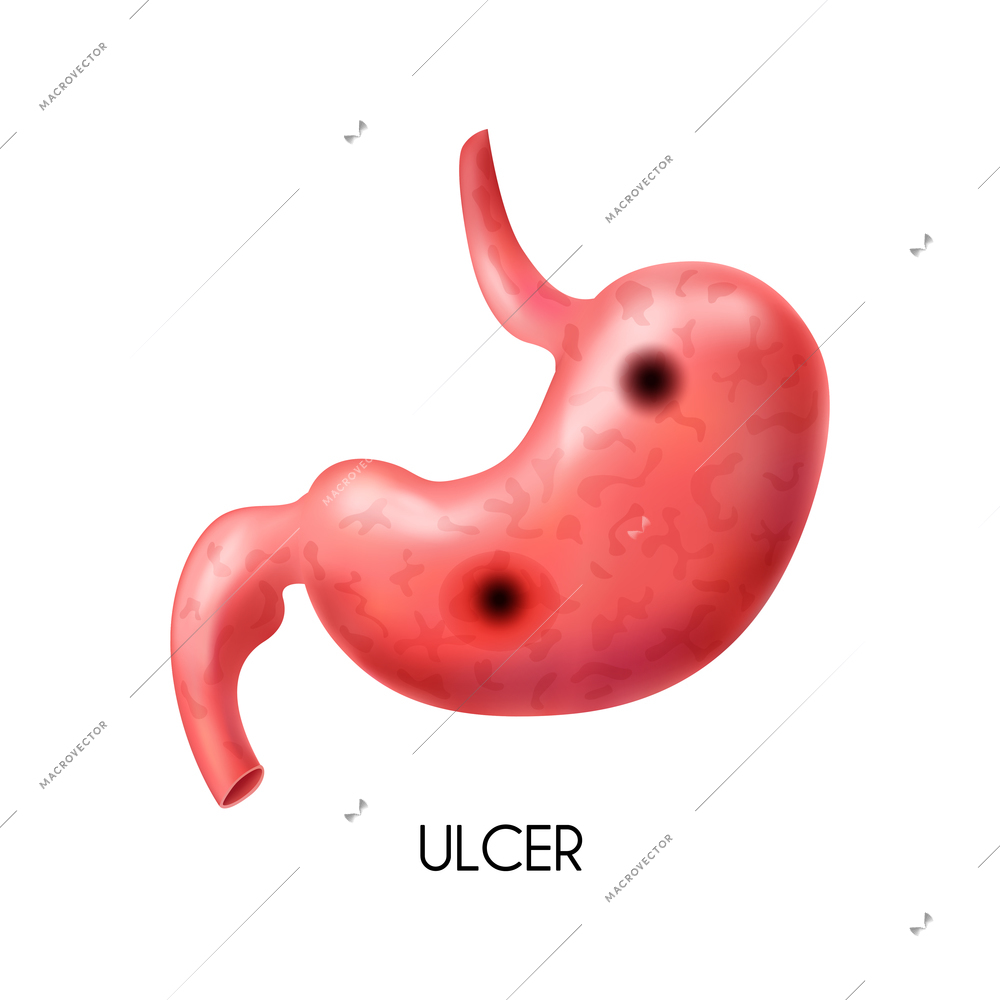 Realistic human internal organ stomach with ulcer on white background vector illustration