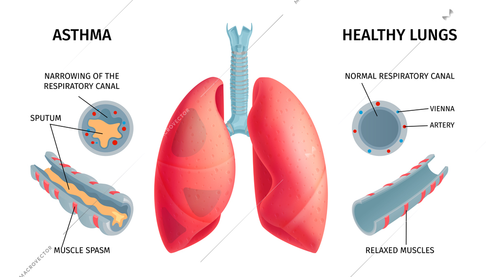 Human lung anatomy respiratory asthma disease symptoms medical educative infochart poster with swollen inflamed airways vector illustration