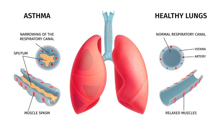 Human lung anatomy respiratory asthma disease symptoms medical educative infochart poster with swollen inflamed airways vector illustration