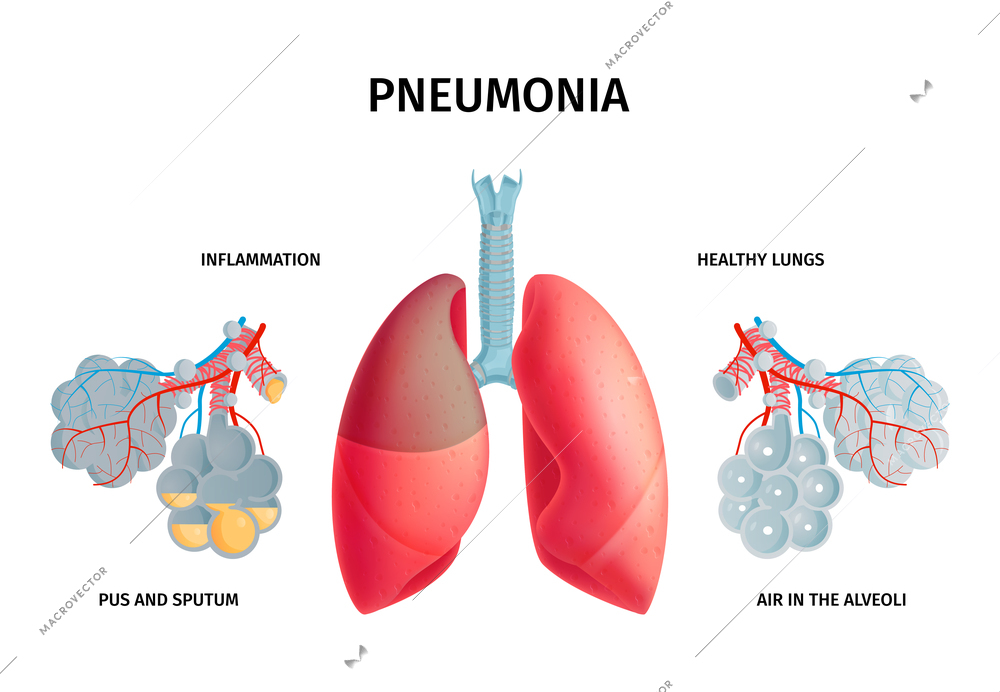 Human lung anatomy infection disease inflammation pneumonia symptoms causes medical colorful educative poster pictorial chart vector illustration