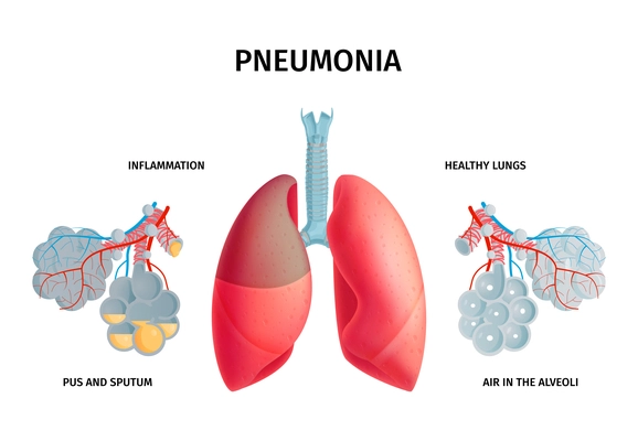 Human lung anatomy infection disease inflammation pneumonia symptoms causes medical colorful educative poster pictorial chart vector illustration