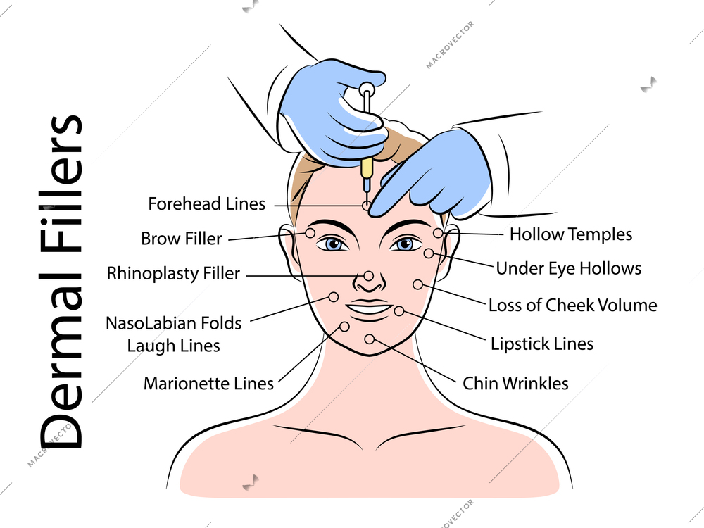 Skin care medical infographics scheme with fixing areas for dermal filler injections flat vector illustration