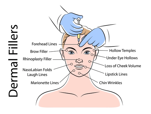 Skin care medical infographics scheme with fixing areas for dermal filler injections flat vector illustration