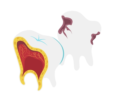 Dentistry isometric icon with decayed teeth structure 3d vector illustration