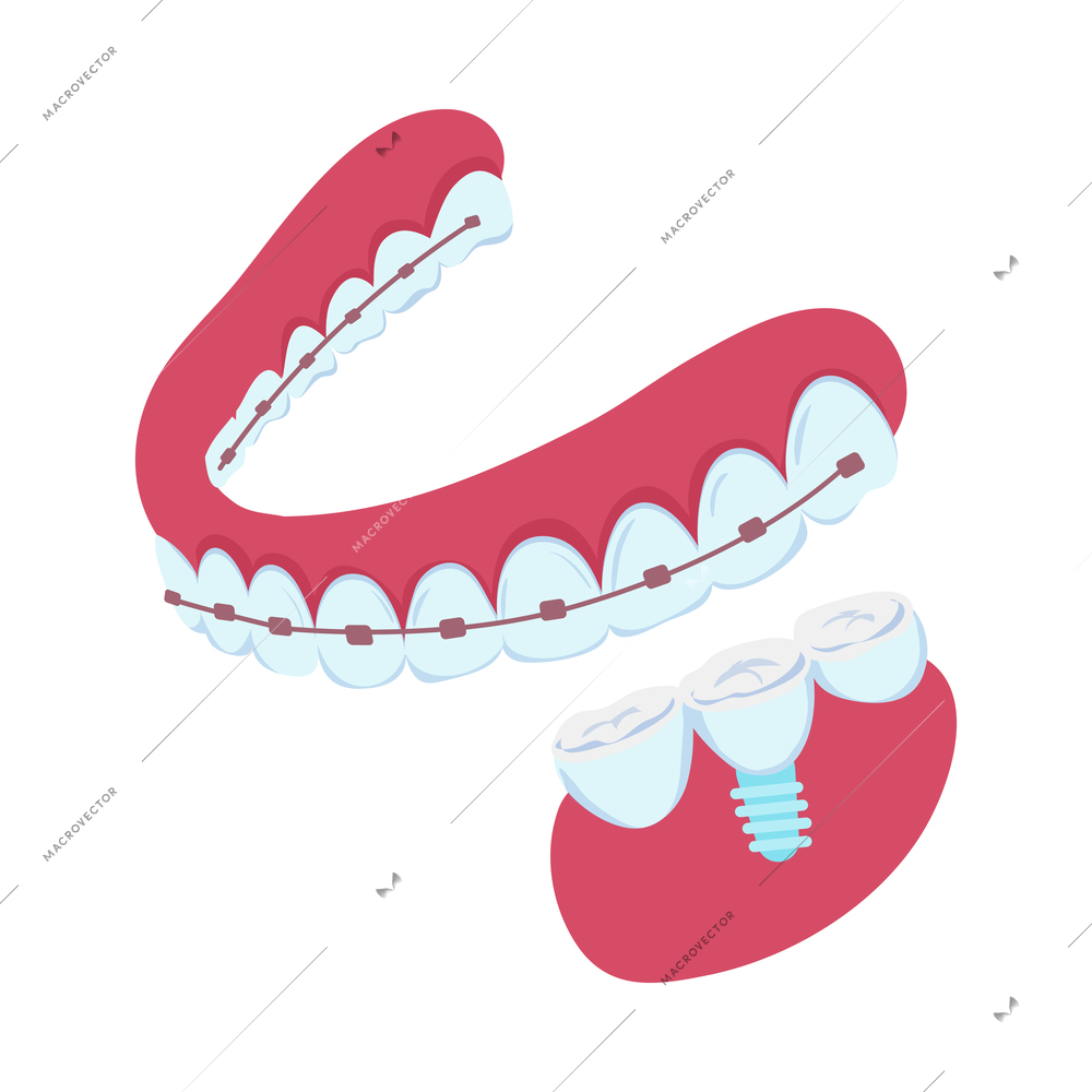 Dentistry isometric icon with dental implant and braces on teeth 3d isolated vector illustration