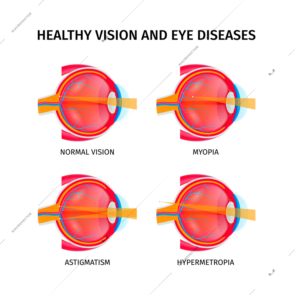 Human eye anatomy set with vision disorders symbols isometric isolated vector illustration