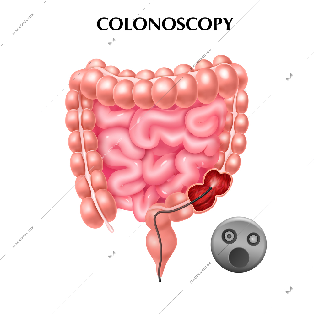 Colonoscopy procedure colored poster with intestine anatomy and colonoscope used for colon diagnostics realistic vector illustration