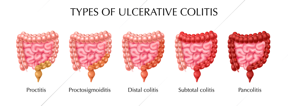 Ulcerative colitis types infographics including proctitis distal colitis pancolitis proctosigmoiditis subtotal colitis realistic vector illustration