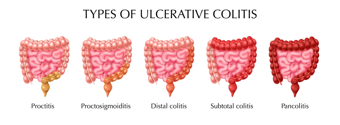 Ulcerative colitis types infographics including proctitis distal colitis pancolitis proctosigmoiditis subtotal colitis realistic vector illustration