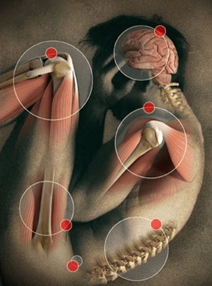 CASTOR-SASA.22.01.2023.pain-hotspots.jpg_‎-_Photos53BCB4B5-AB99-4B6D-A385-C596A6B8E7C7.jpg