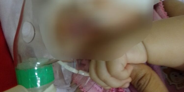 Bebê de quatro meses com pneumonia morre após não conseguir vaga em UTI de Imperatriz