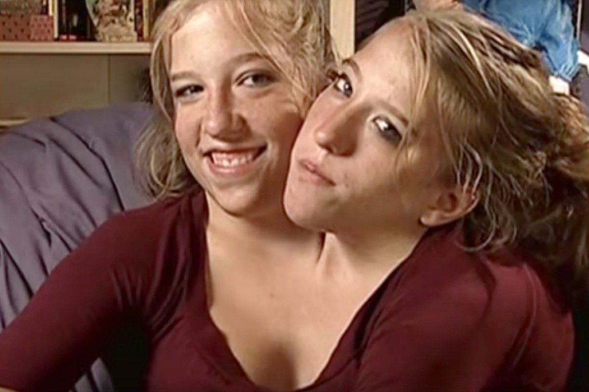 Abby and brittany hensel conjoined twins rewamodel