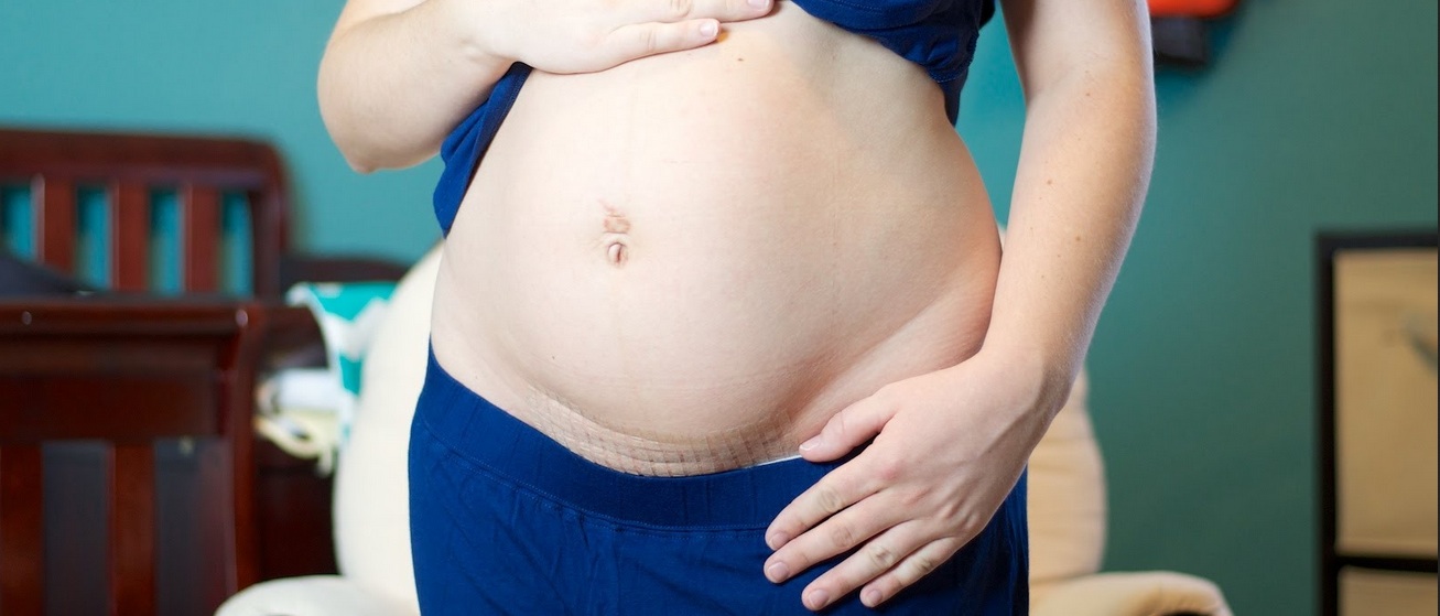 The appearance of your stomach after a caesarean section