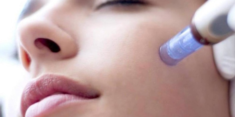 Laser ανάπλασης vs Microneedling