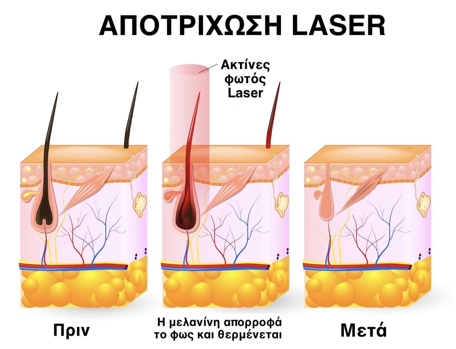 Πότε πέφτουν οι τρίχες μετά την αποτρίχωση με λέιζερ Αλεξανδρίτη;