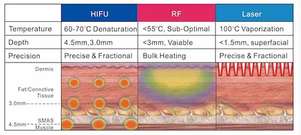 Laser vs. HIFU & RF: Πόσο βαθιά φτάνουν οι τεχνολογίες στην αισθητική ιατρική;
