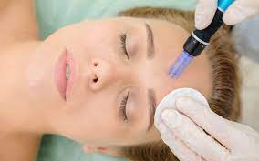 Γιατί να επιλέξετε το Microneedling για θεραπεία προσώπου?
