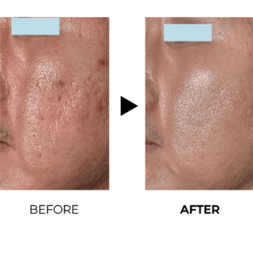 JuveLook: Η Επαναστατική Θεραπεία Skinbooster