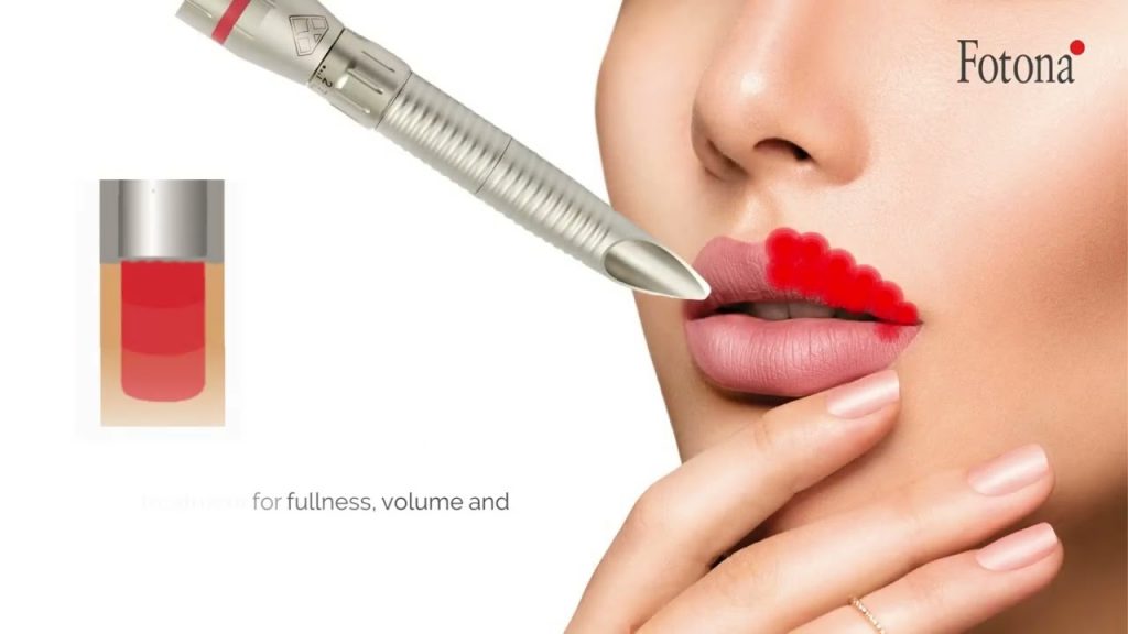 LipLase™ – Φυσική Αύξηση Όγκου & Ανόρθωση Χειλιών με Laser