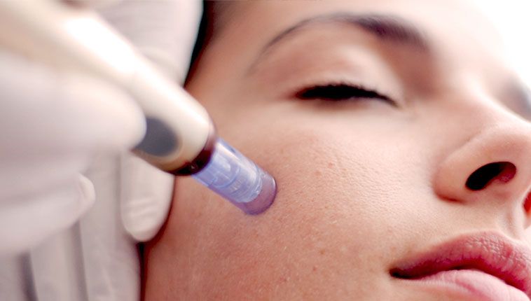 Microneedling για Ουλές Ακμής και Ραγάδες…Aξίζει τον κόπο!