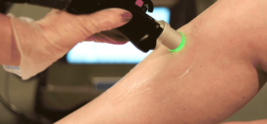 Πώς λειτουργεί η αποτρίχωση laser…