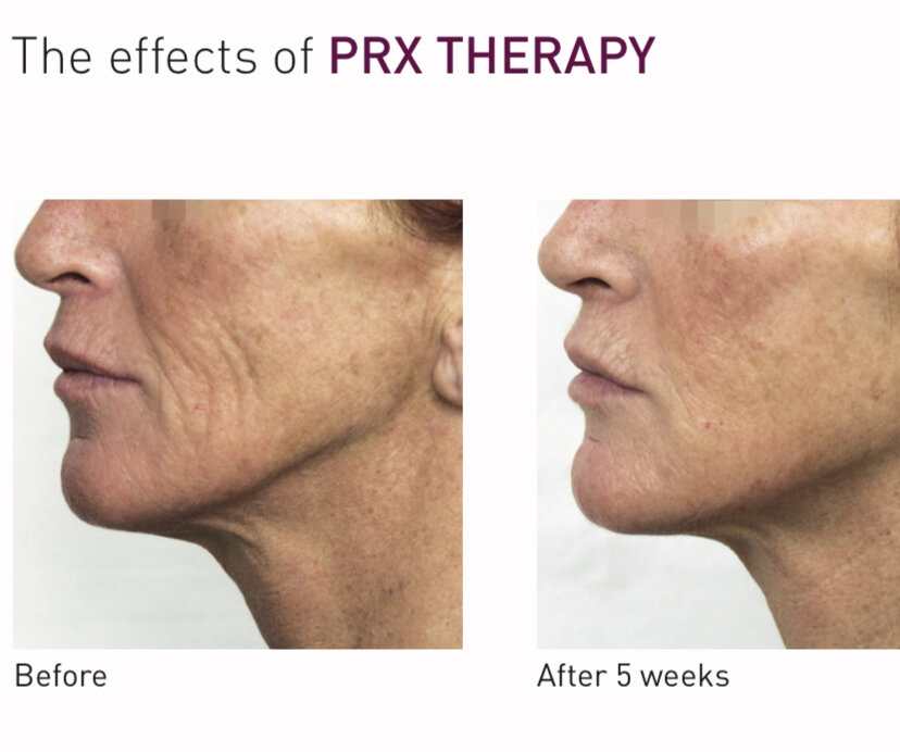 Δράση του peeling PRX-T33® στο δέρμα