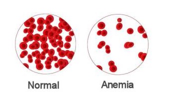  Anemia Obat dan Herbal Tradisional Manfaat co id